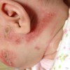 粉をふくどころじゃ済まない！赤ちゃんの肌荒れ対策にステロイドを恐れるな！